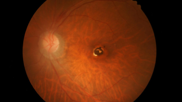 الثقوب الشبكية..كيف تحدث ولماذا ؟ - فيديو