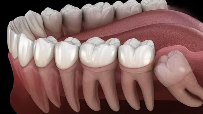 ما هي أسباب الانطمار في ضرس العقل ؟