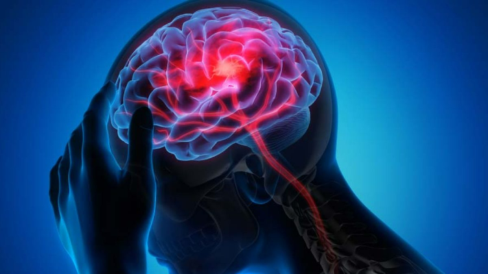 العلاج الطبيعي للسكتة الدماغية .. متى نلجأ له؟ - فيديو