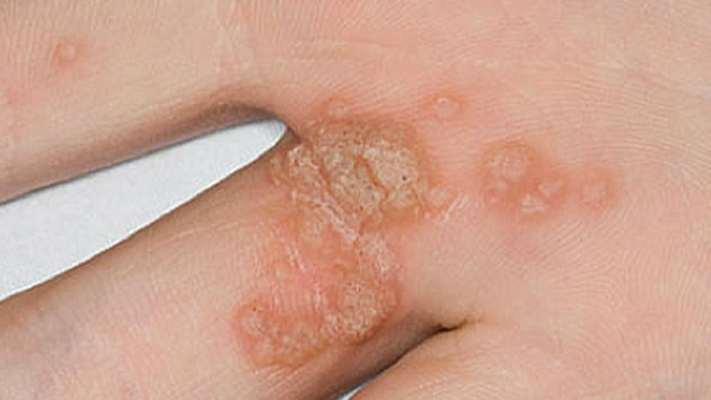 هل تتحول الثآليل لأورام سرطانية؟ - فيديو