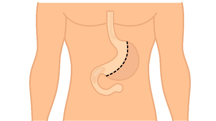 بعد وفاة نجل جورج وسوف .. ما هي مخاطر عملية ربط المعدة؟