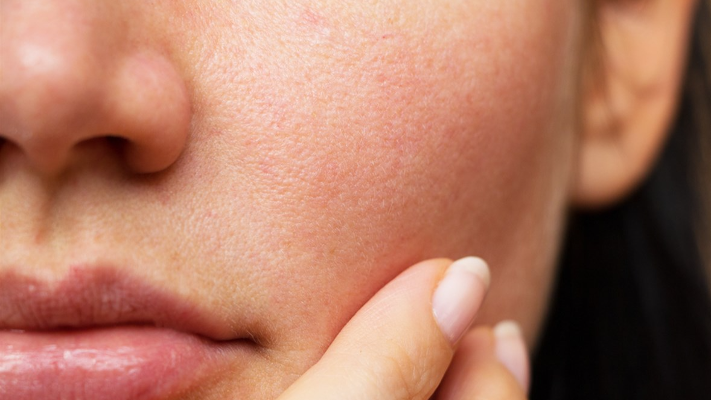 Large Pores Treatment Cost in Dubai Explained for Patients