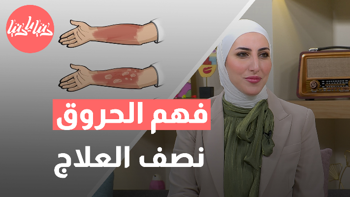 5 خطوات ضرورية جدأ عند علاج الحروق - فيديو