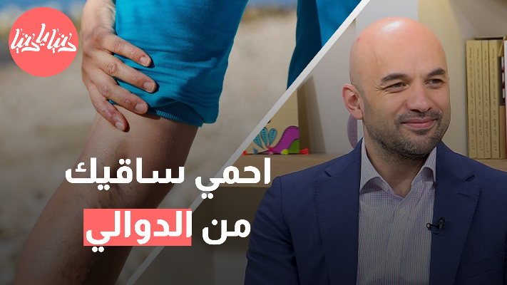 كيف نتفادى الإصابة بدوالي الساقين؟ - فيديو