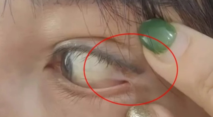 خطأ في عملية تجميل لامرأة يؤدي إلى خياطة جفنها بزاوية عينها