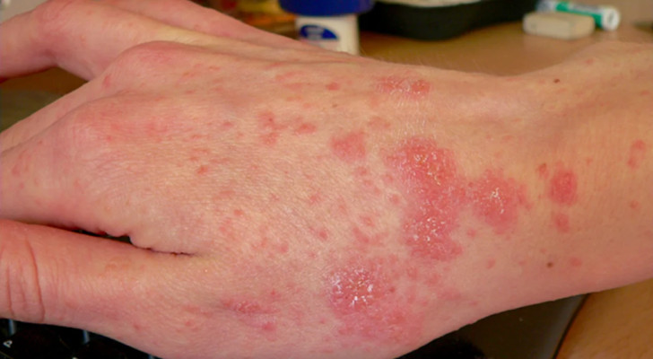 كيف ينتقل الجرب وما هي أسبابه وطرق علاجه؟