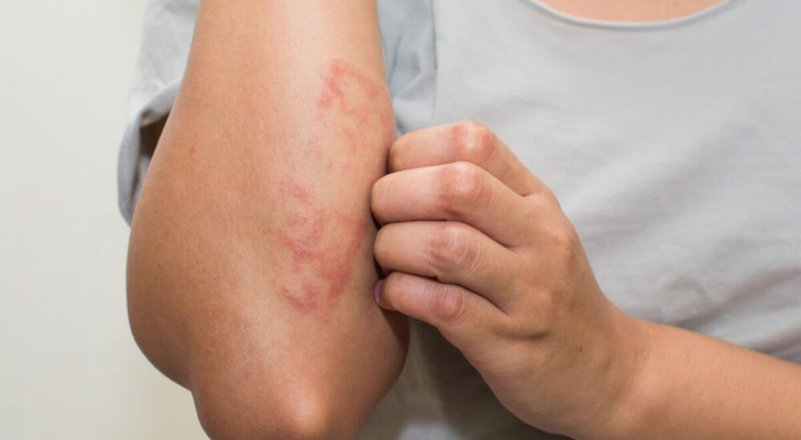أفضل طرق علاج حساسية الجلد: كيف تتخلص من الحكة والاحمرار سريعا!