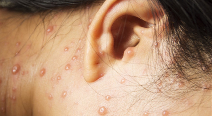 اليمن تسجل أول إصابة بمرض جدري الماء!