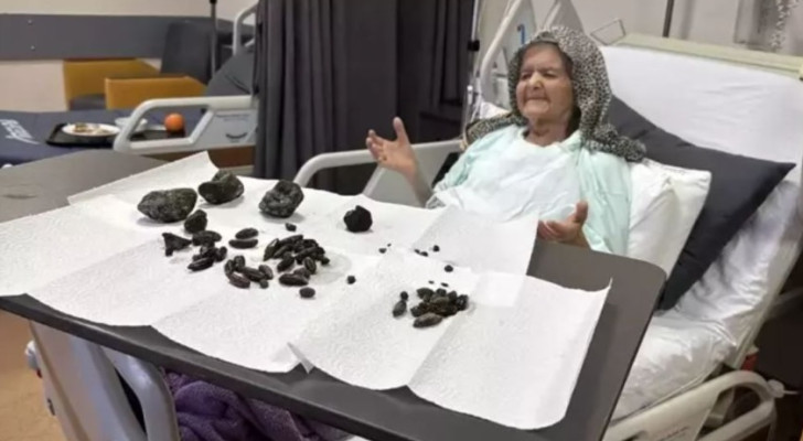 أطباء في تركيا يستخرجون أجساما غريبة من معدة مسنة تبلغ 92 عاما