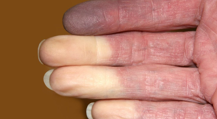هل تعاني من خدر وابيضاض في أصابعك في الطقس البارد؟ إليك التفسير والعلاج