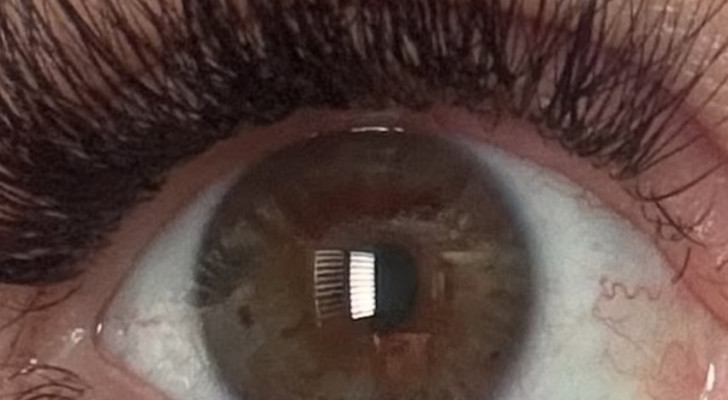صاعقة برق تصيب شابة فتغير لون عينيها بطريقة مذهلة!