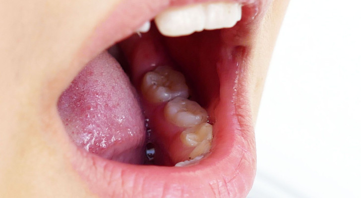 3 أعراض في الفم يجب ألا تهملها أبدًا: قد تكون إنذارًا مبكرًا للسرطان!