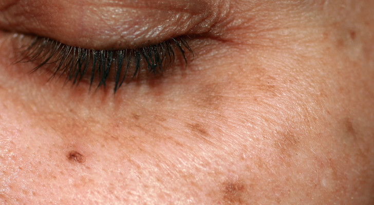 3 علامات جلدية لا تتجاهلها.. فقد تشير لمرض عضوي كامن!