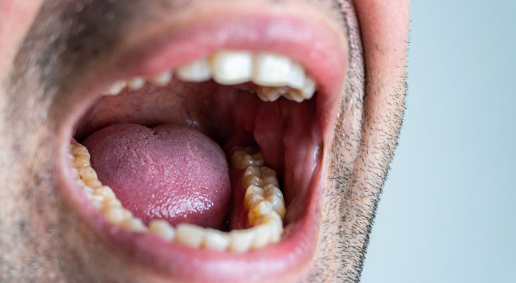 انتبه .. علامات تظهر في باطن الخد قد تشير لوجود سرطان في التجويف الفموي