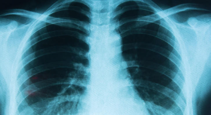 سرطان الرئة يهدد غير المدخنين.. العلماء يكشفون السبب الصادم!