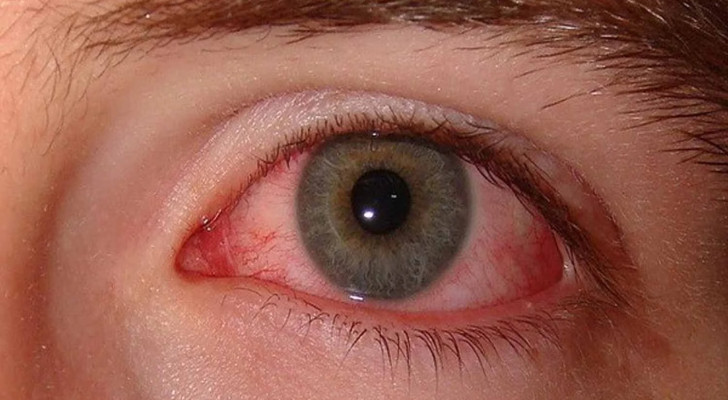 إنفلونزا العيون.. ما هي؟ وكيف تميز أعراضها عن أمراض العين الأخرى؟