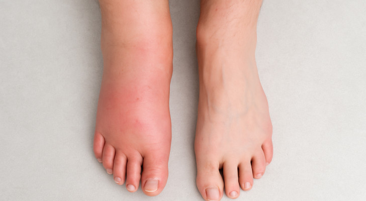 انتبه! تورم قدم واحدة قد يشير إلى مشكلة صحية خطيرة .. وهذه هي الأسباب
