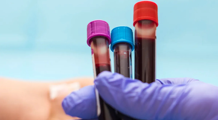 دوخة؟ تساقط شعر؟ شحوب؟ إليك الفحوصات التي ستكشف عن مشكلتك