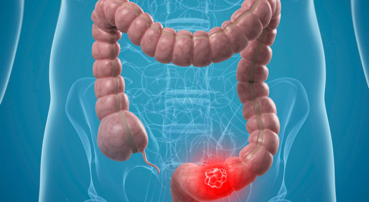 خبراء يحذرون: مواليد 1990 معرضون أكثر لسرطانات الجهاز الهضمي.. ما السبب؟
