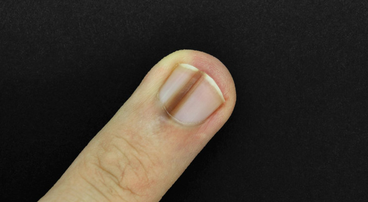 الخط الأسود أو البني على الأظافر: سبب بسيط شائع أم ورم خبيث؟