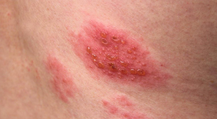 ليس حول الخصر فقط.. أماكن أخرى يظهر فيها الحزام الناري يجب أن تعرفها