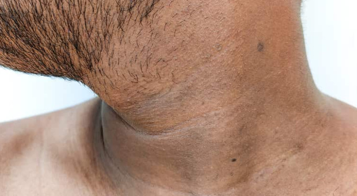 "الشواك الأسود".. عرض جلدي قد ينذر بارتفاع السكر في الدم!