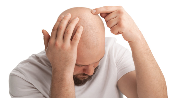 يعيد إنبات الشعر سريعا .. دواء يعالج جميع أنواع  الصلع في 3 أسابيع!