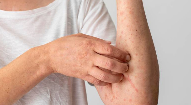 علامات إذا ظهرت على جلدك قد تشير لبداية الفشل الكلوي.. احذرها