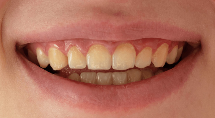 ابتسامتك بخطر! هذه الأشياء اليومية تصبغ أسنانك دون أن تشعر