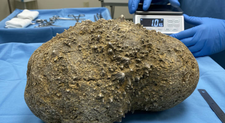 حالة نادرة جدا.. استخراج حصوة عملاقة تزن 1 كلغ من مثانة رجل (65 عاما)!