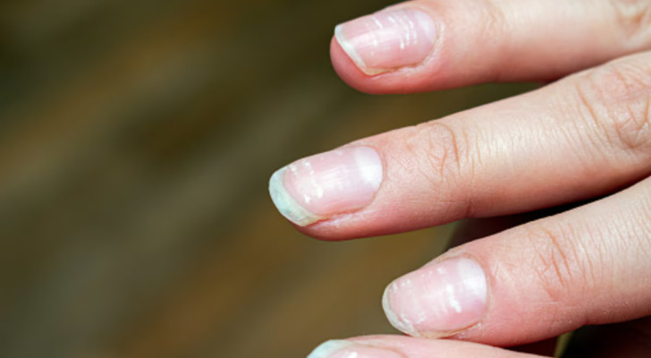 سؤال وجواب: لاحظت في الفترة الماضية أن أظافري أصبحت مفلطحة (مقعرة ومسطحة في الوقت نفسه). هل هذا الأمر خطير؟