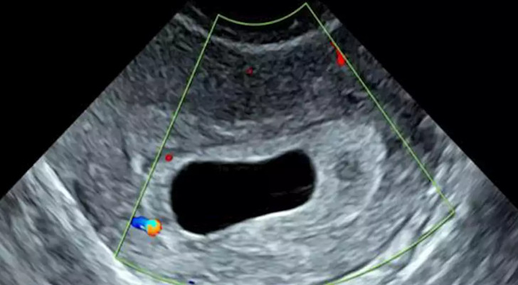 سؤال وجواب: بعد إجراء فحص الحمل المنزلي ذهبت للطبيب… وكانت النتيجة (كيس حمل فارغ): ماذا يعني ذلك؟