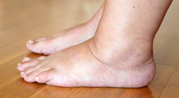 لمرضى السكري: إذا شعرتم بهذه الأعراض فأنتم تعانون من الاعتلال العصبي الطرفي أو تكلس الأوردة الطرفية