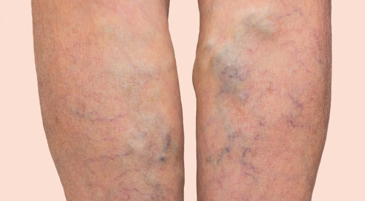 5 علاجات طبيعية سحرية لدوالي الساقين