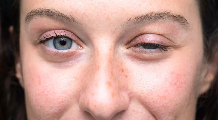 هذا المرض لا يؤلم… ولكنه يغير ملامح الوجه بالكامل صورة صادمة! ما هو؟