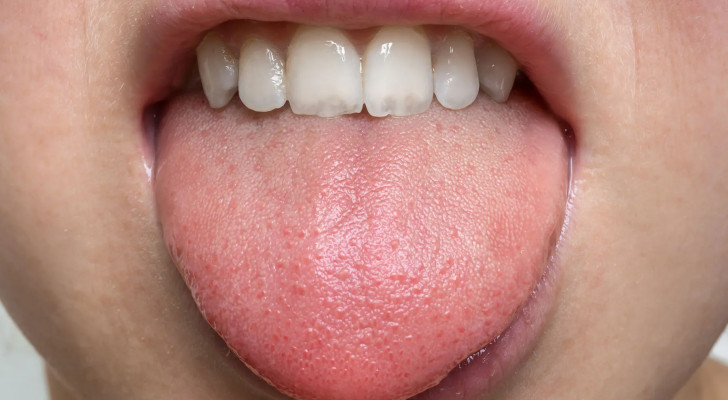 تيبس الرقبة وخدر اللسان: مرض عصبي نادر.. ماذا تعرف عن متلازمة الرقبة واللسان؟