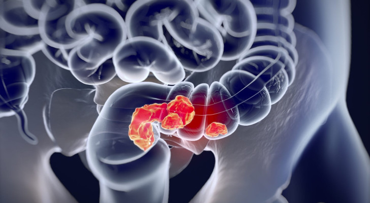 انتبه جيدا: شكل البراز.. لونه.. وحجمه.. متى يكشف سرطان القولون؟