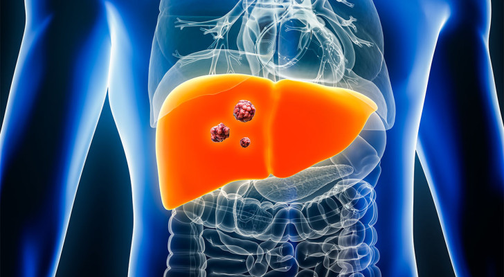 ما أعراض بدء انتشار السرطان من الكبد إلى العقد اللمفاوية في الجسم؟