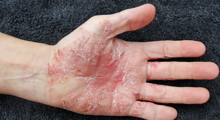 شاب يعاني من بقع جلدية جافة ومتشققة خلف مفاصله وفي كف اليد: ما التشخيص الصحيح؟