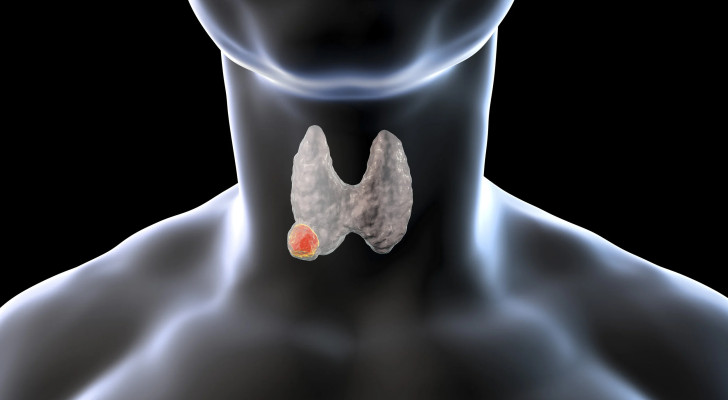 أعراض مبكرة: علامات يجب الانتباه إليها فقد تشير لسرطان الغدة الدرقية