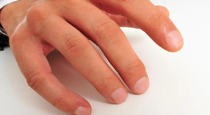 علامة على أصابعك قد تكشف سرطان الرئة قبل ظهور الأعراض!