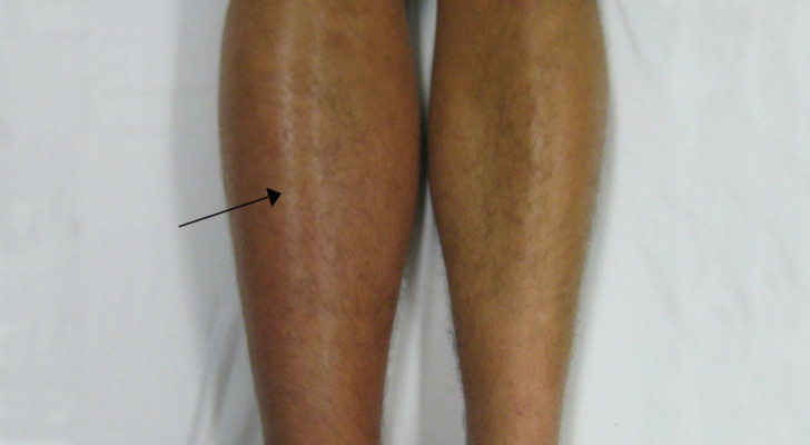 أخطر أنواع الجلطات: كيف تعرف إذا ظهرت عليك أعراض جلطة الساق؟