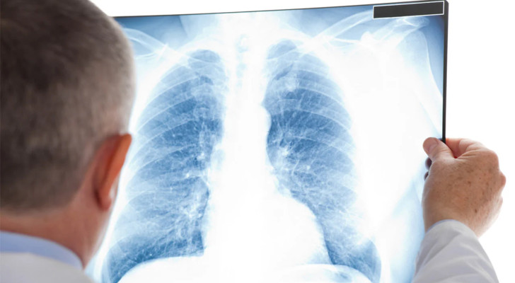 جلطة الرئة المفاجئة: هذه الأعراض قد تنقذ حياتك إذا تعرفت عليها!