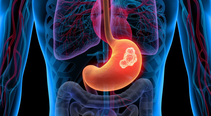 متى يكون فقر الدم ونقص الحديد علامة على سرطان المعدة؟