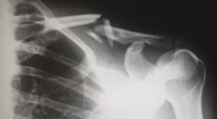 أبحاث تثبت: كثرة الكآبة تنخر العظام وتزيد هشاشتها!