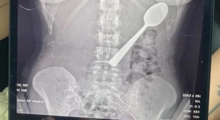 أغرب حالة طوارئ.. امرأة تبتلع ملعقة بطول 17 سنتيمترا عن طريق الخطأ! وهذا ما حل بها