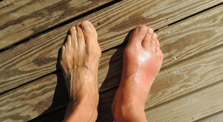 ما علاج ارتفاع اليوريك أسيد في الجسم؟