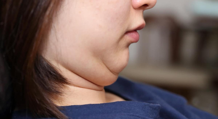 متى يكون اللغلوغ (الذقن المزدوج) علامة خطر؟