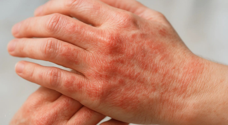 الإكزيما والصيام: 5 أسباب تجعل الجلد يشتعل حكة وجفافا