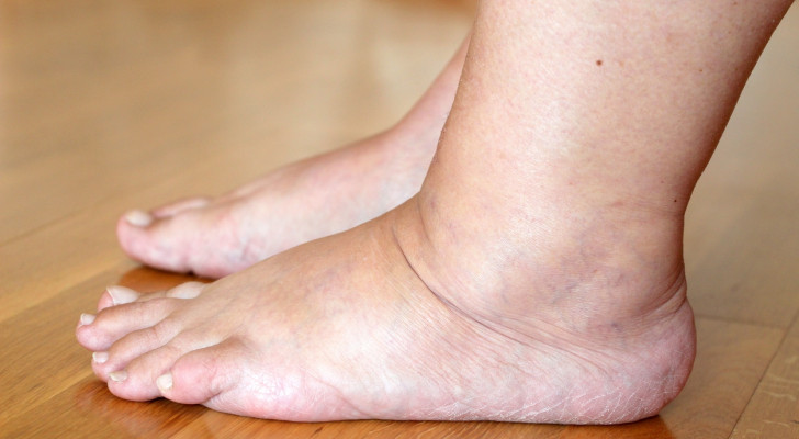 ما أعراض جلطة الساق؟ إشارات تحذيرية لا يجب تجاهلها